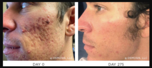 Osmosis Revitapen Spa Facial Results