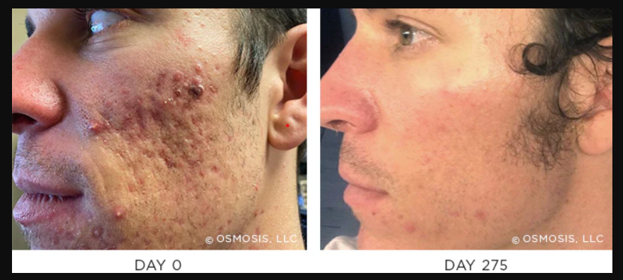 resultsrevitapen Osmosis Revitapen Spa Facial Results